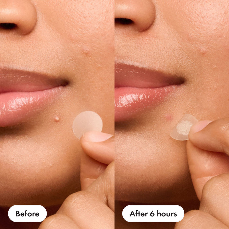 Mighty Patch: Hydrocolloid Pimple Patch